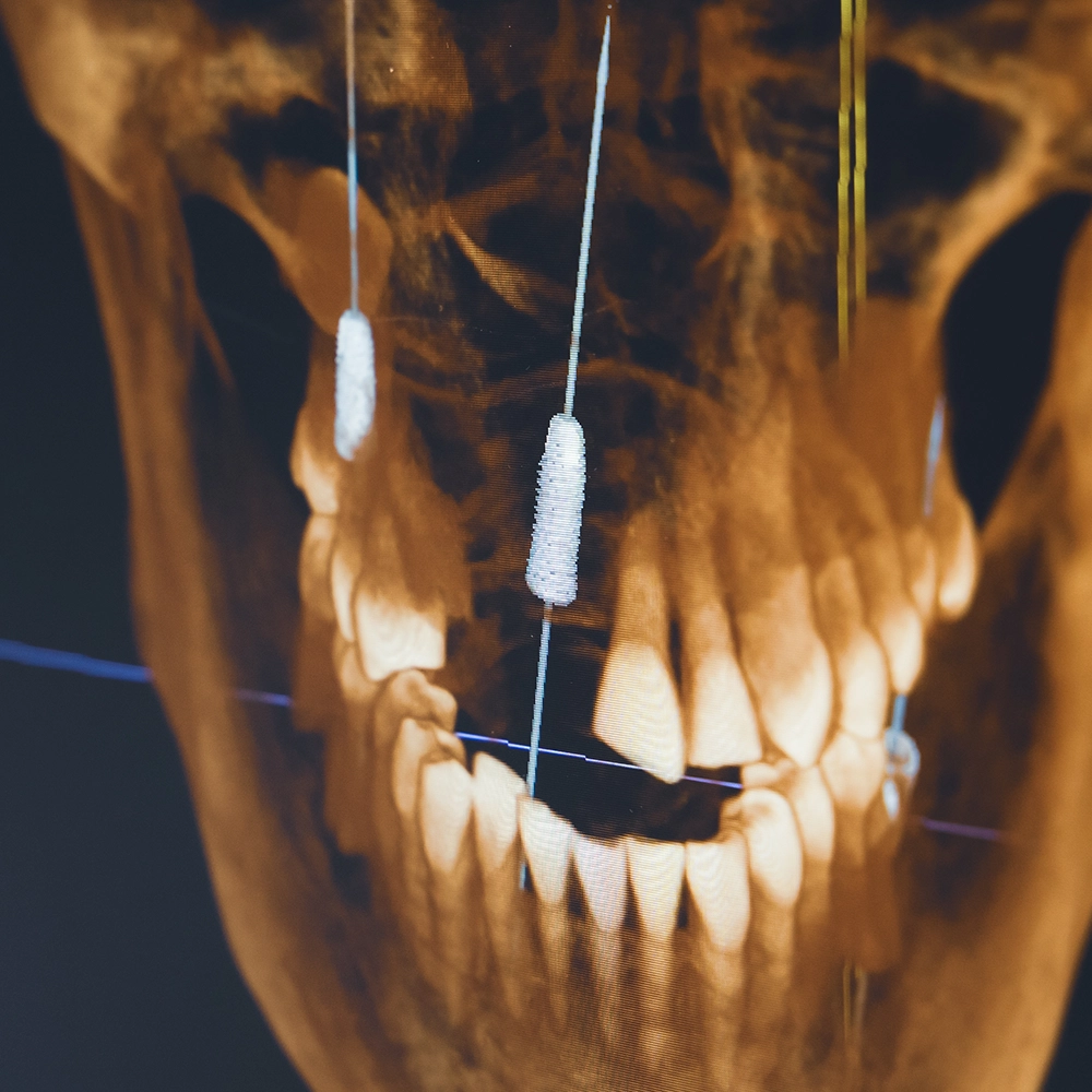 A CT scan of the jaw showing implants.
