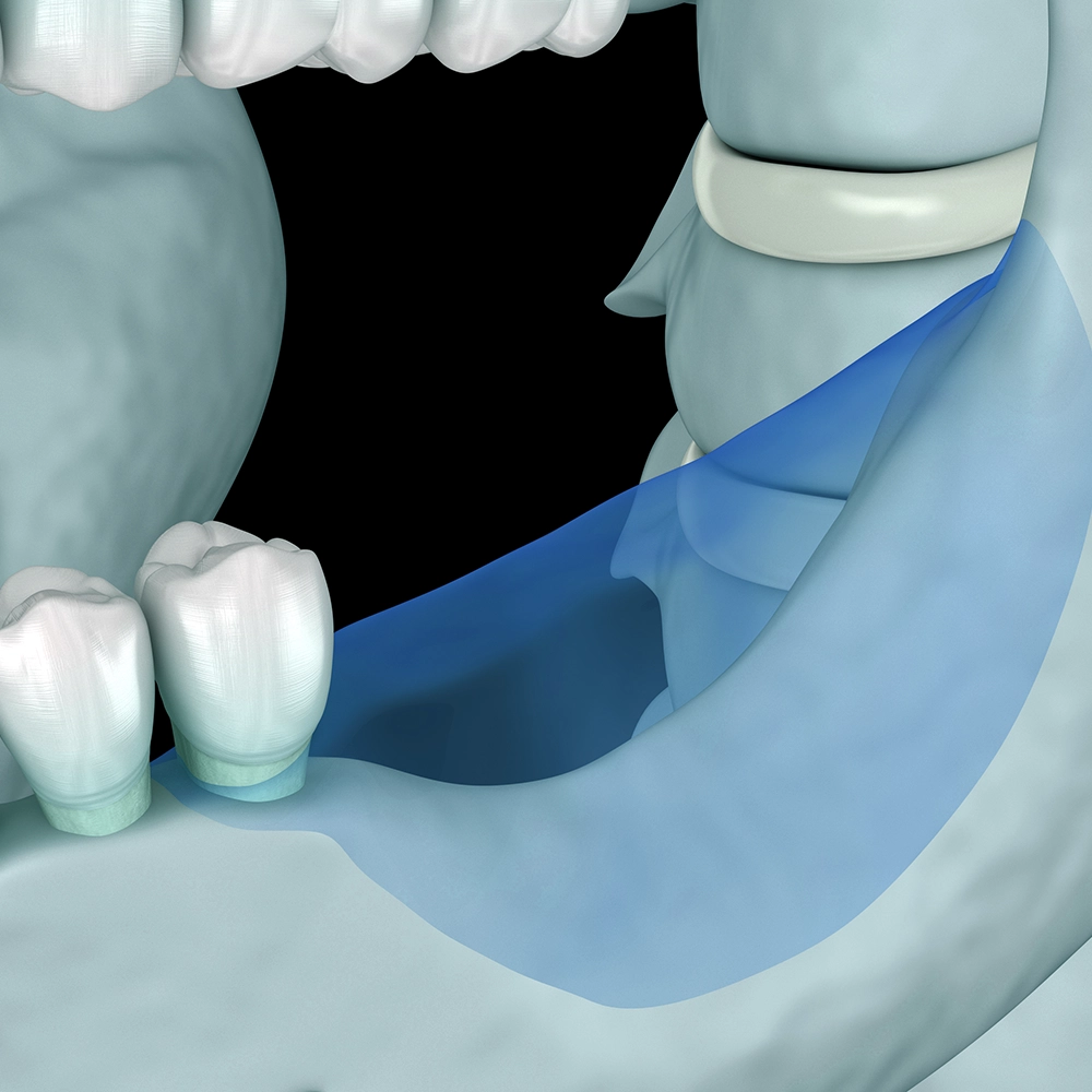3D render illustrating bone loss in the jaw