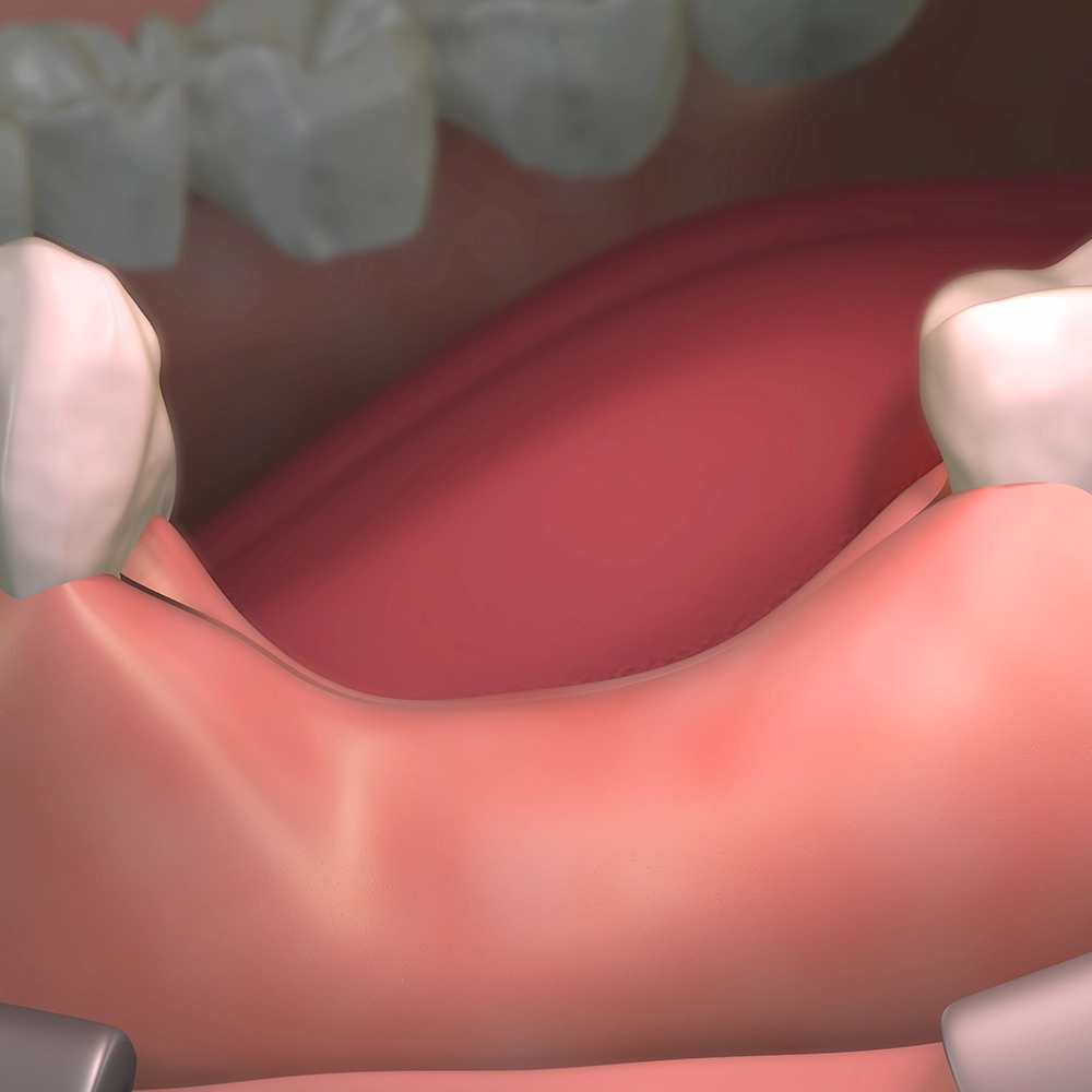 3D render of gums showing bone loss.