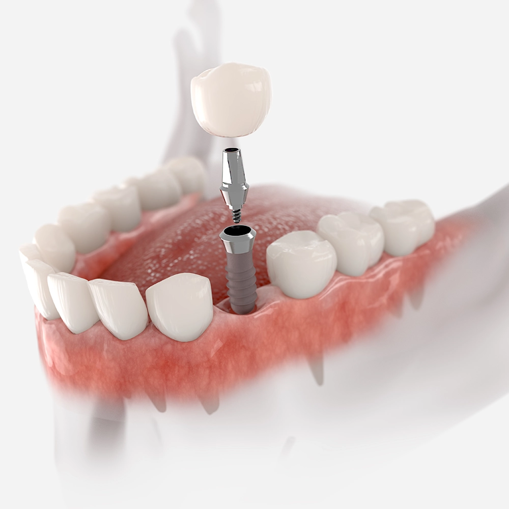 3D illustration of a dental implant being placed.