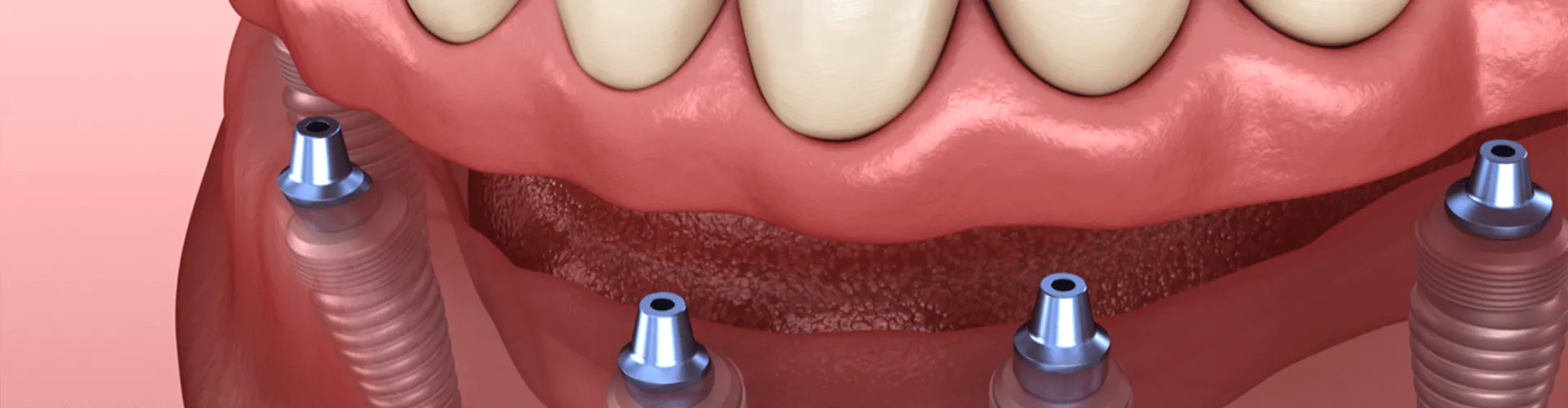3D render of all-on-four.
