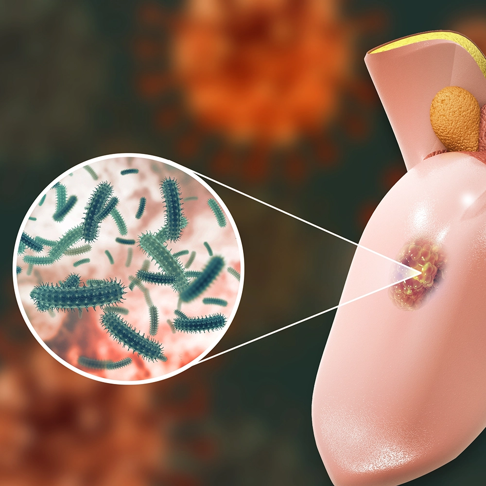3D illustration of oral cancer in the mouth.