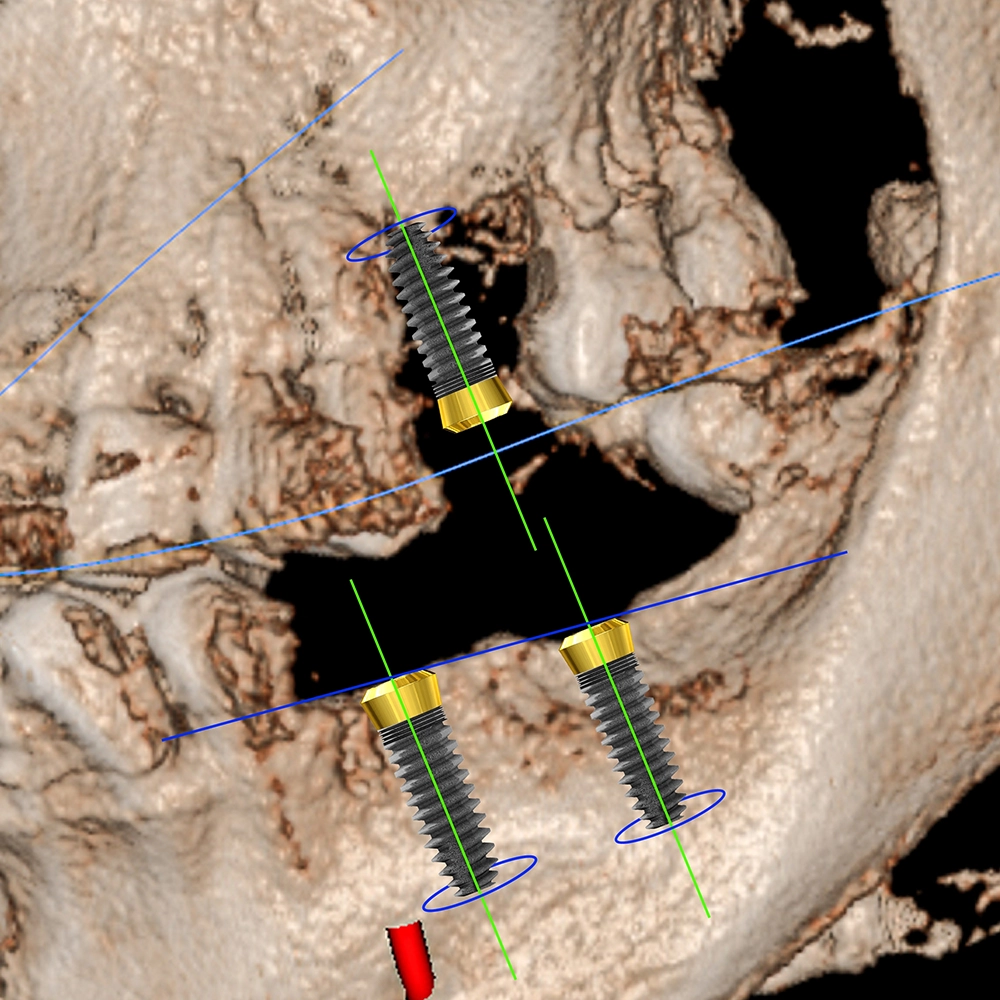 3D scan of a patient's jaw showing planned implant placement.