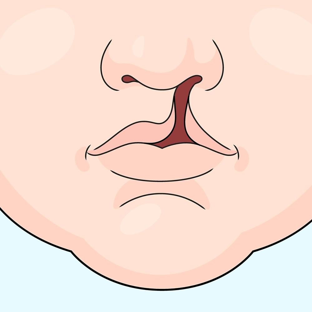 Illustration showing a cleft palate.