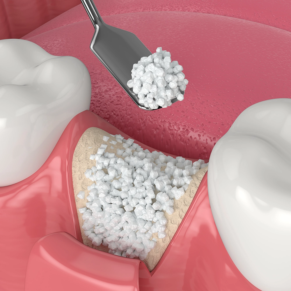 3D illustration of a bone graft.