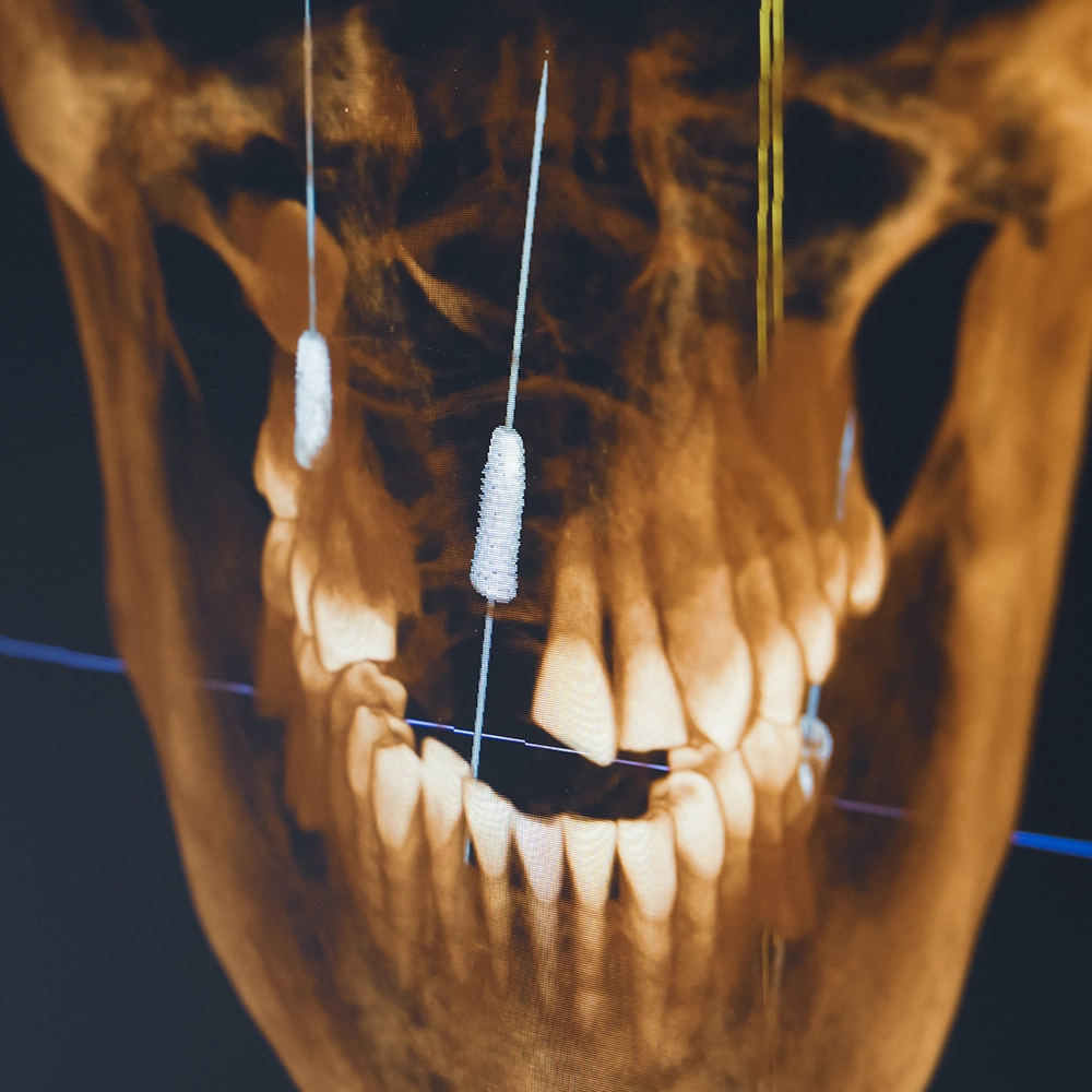 Jaw scan showing planned implant placement.