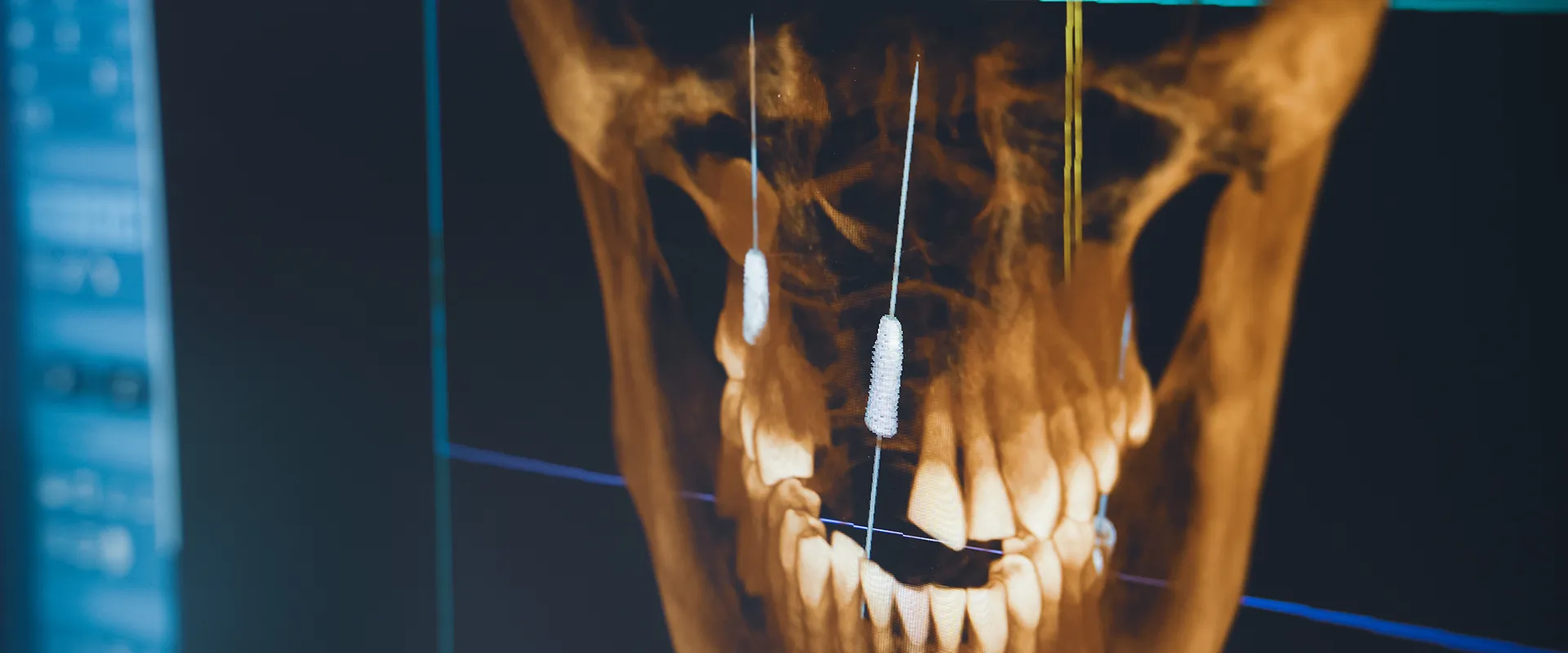 A CT scan of the jaw showing implants.