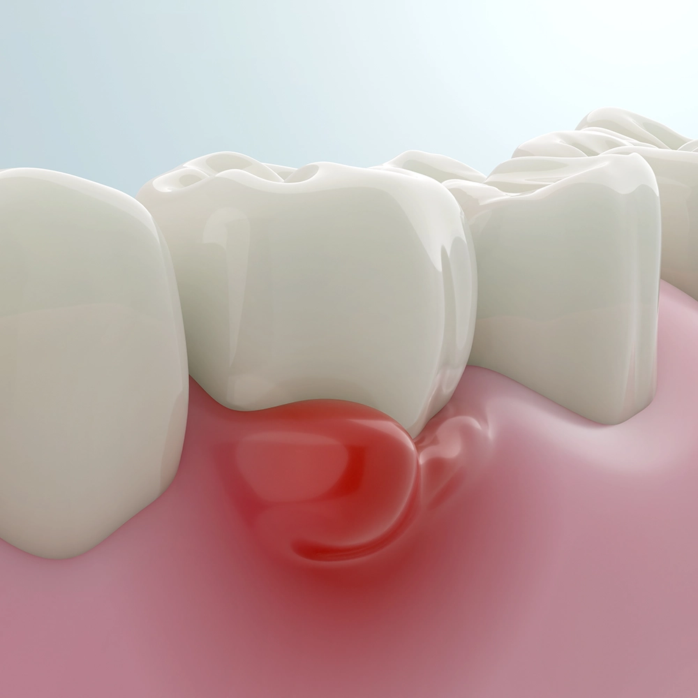3D illustration of an oral cyst or tumor in the mouth.
