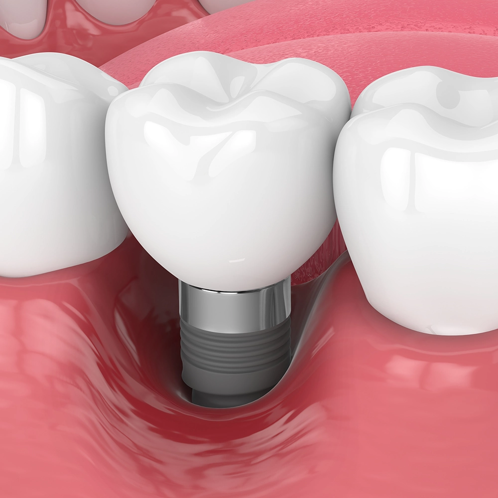 3D illustration of a dental implant being placed.