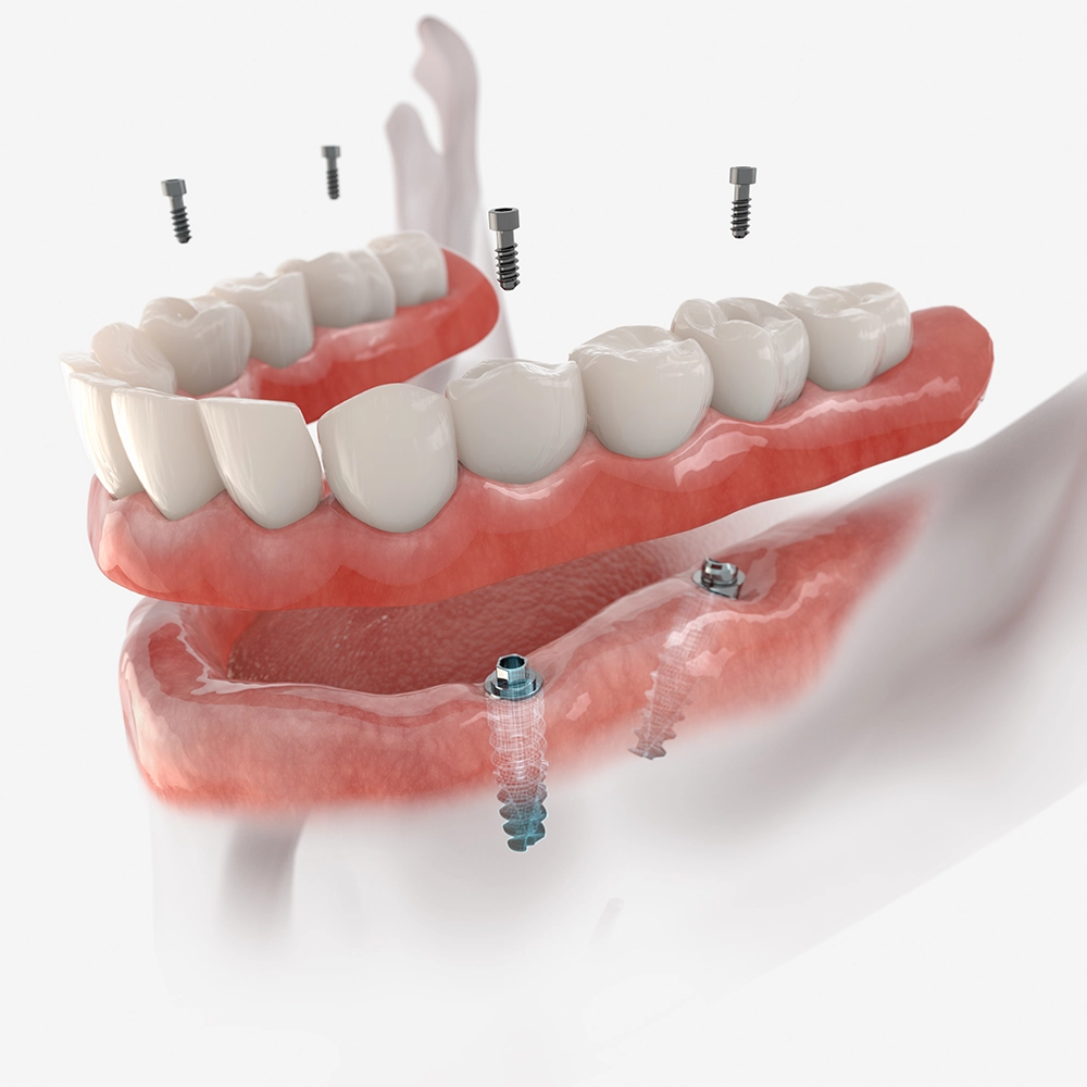 3D illustration of a lower All-on-Four dental implant.