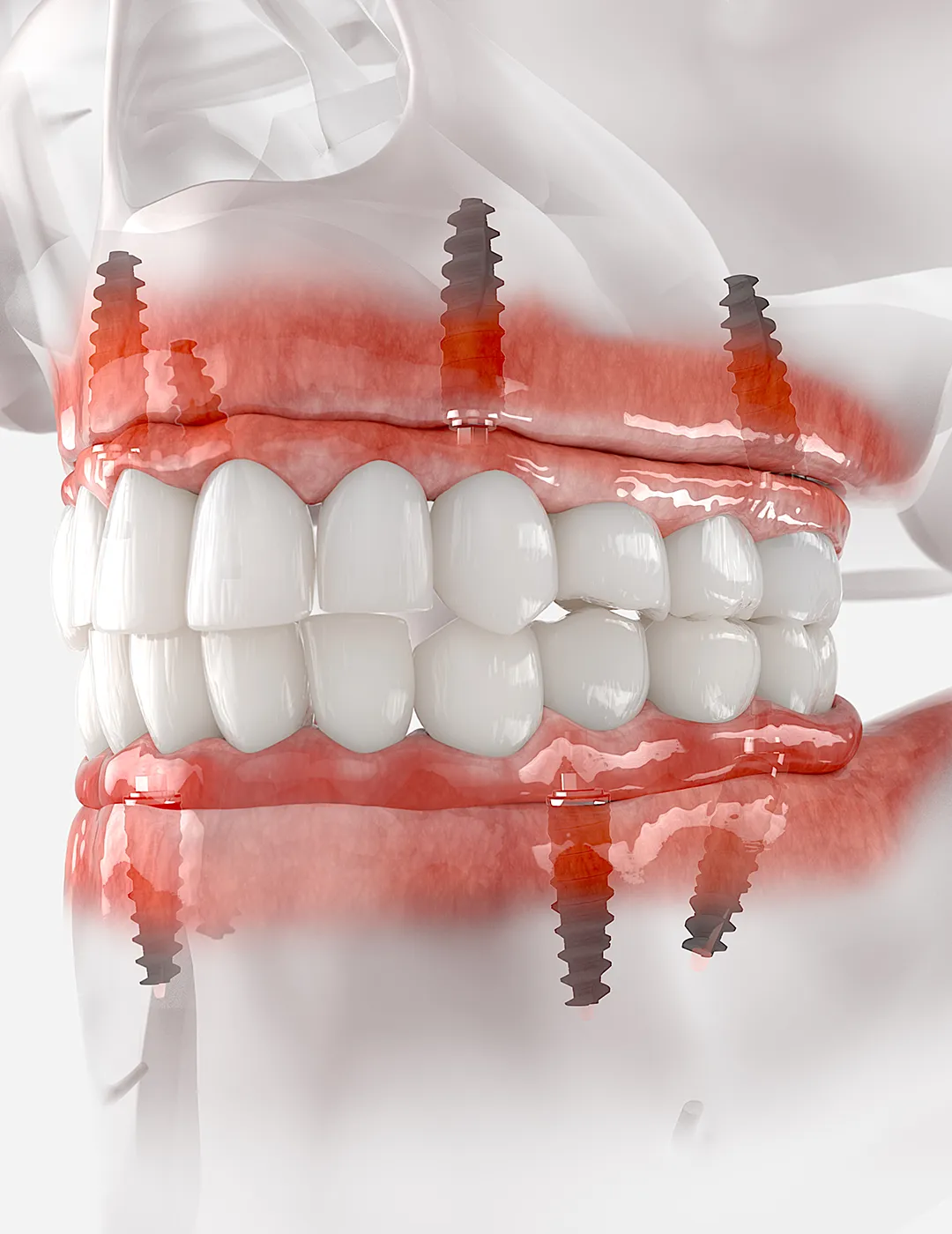 3D render of an All-on-4 dental implant placed on the jaw.