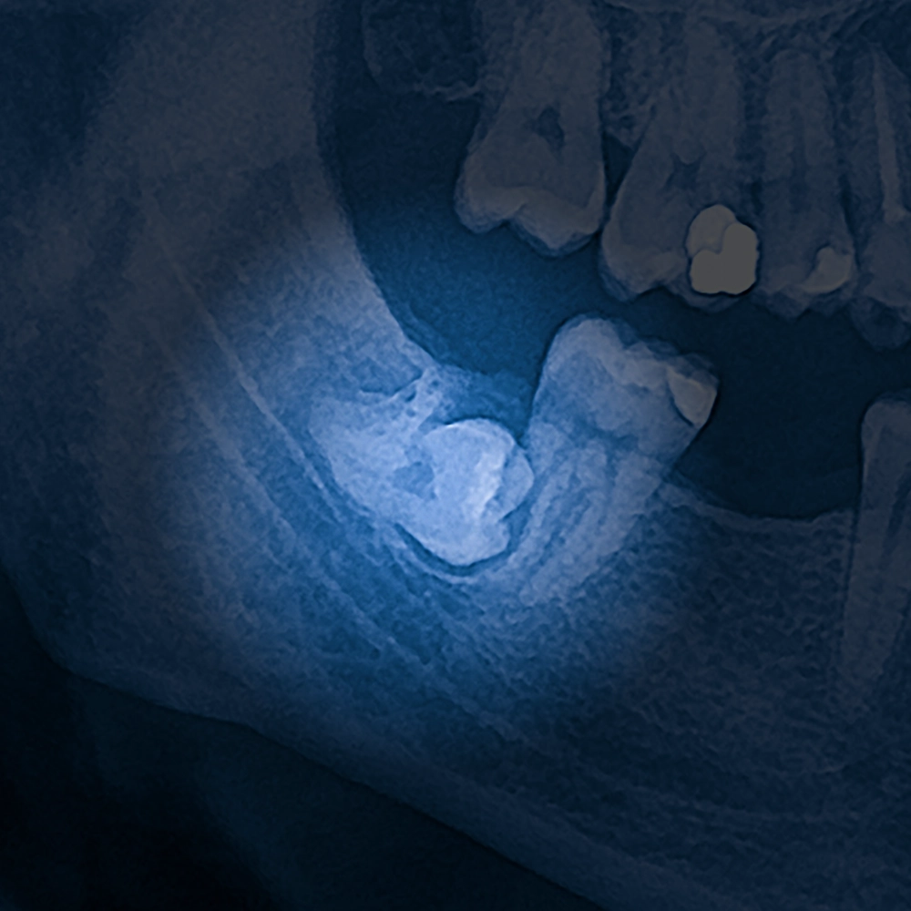 X-rays of an impacted wisdom tooth.