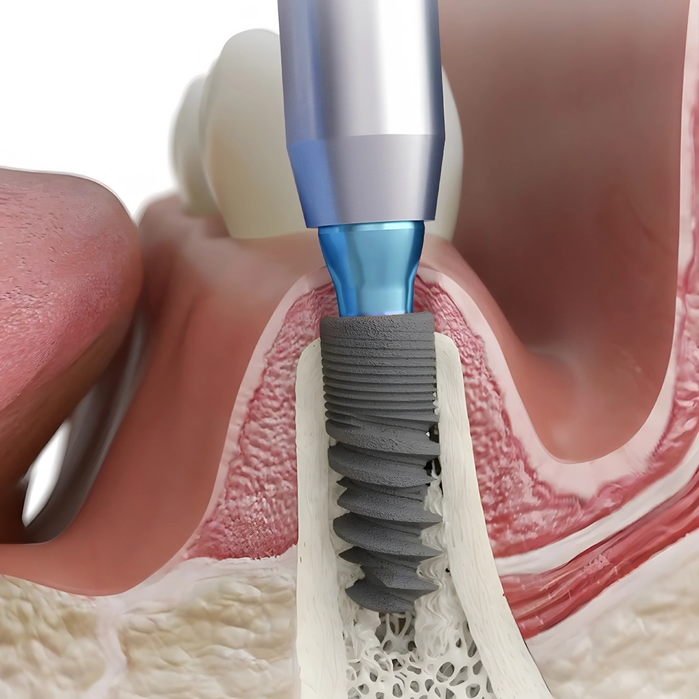 3D illustration of a dental implant being placed.
