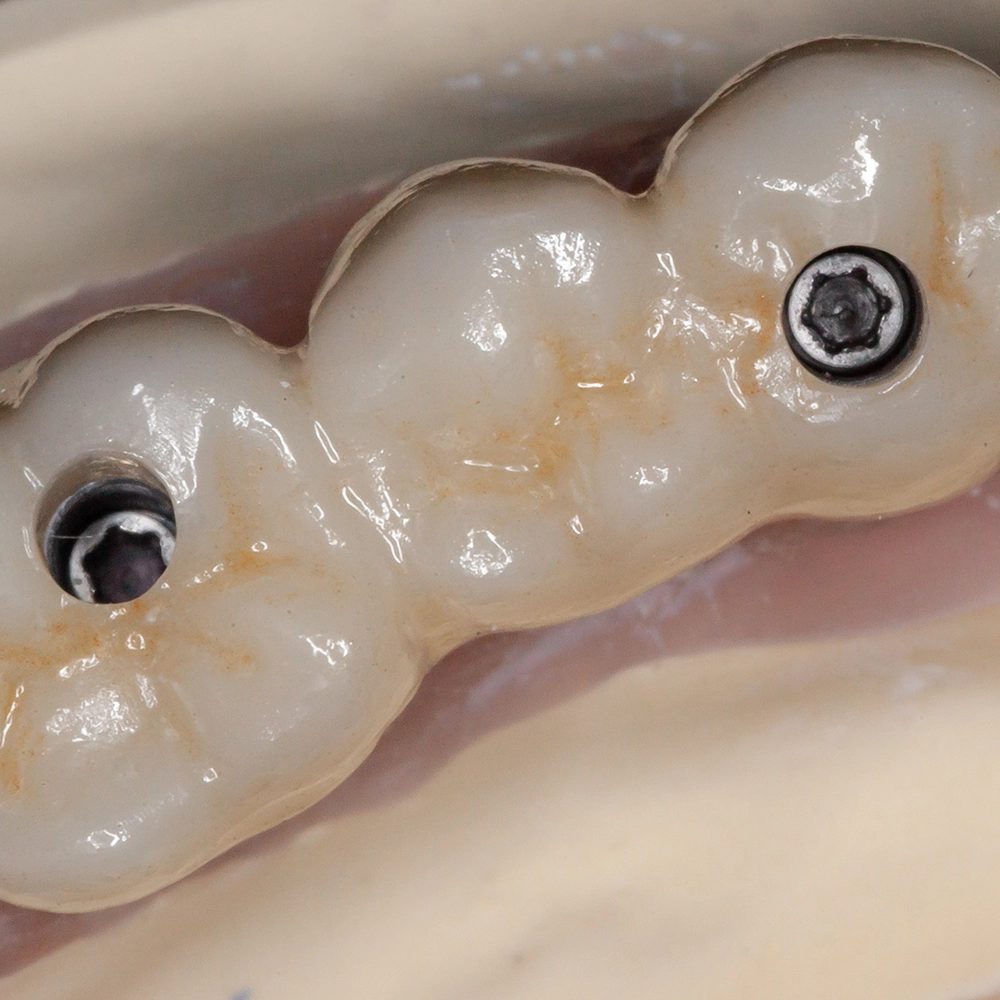 Close-up of a permanent All-on-Four dental arch.