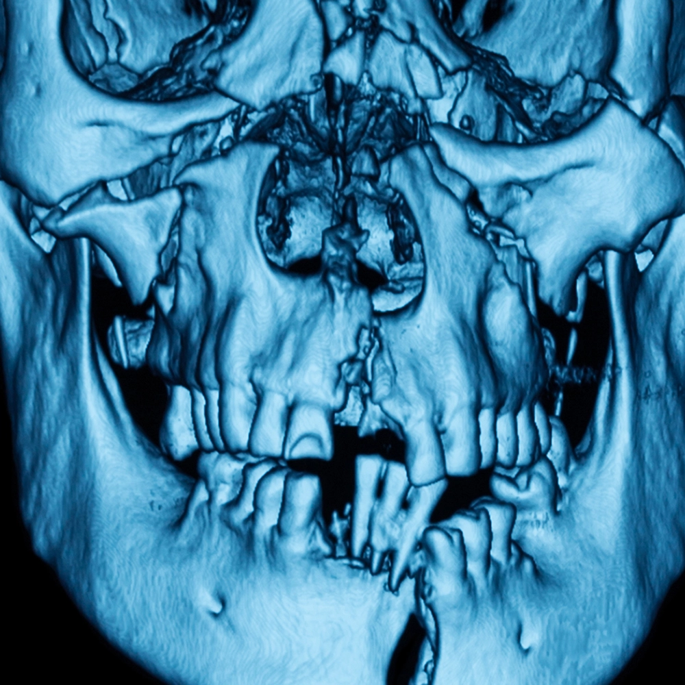 3D scan of a jaw showing trauma.