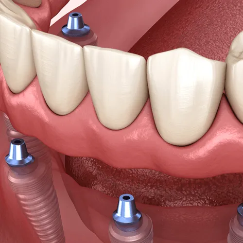 3D render of all-on-four.