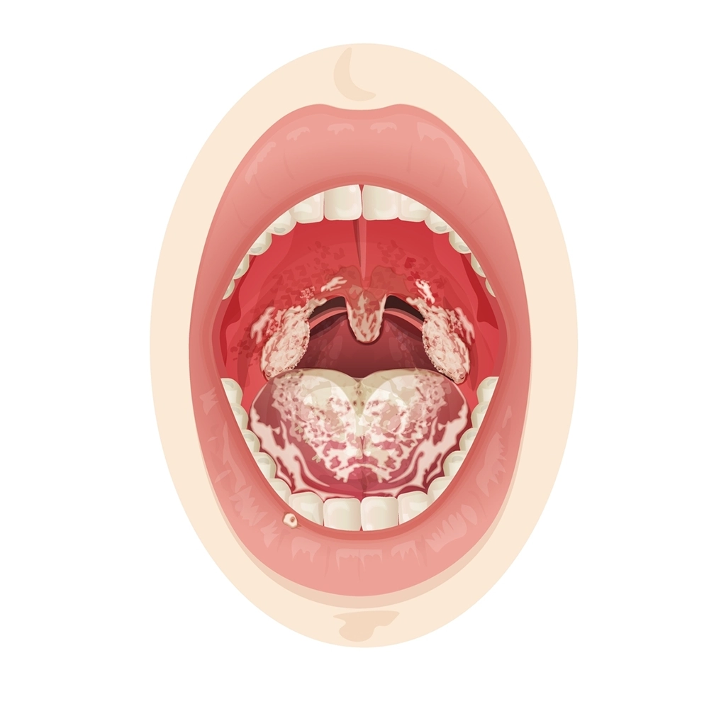 Illustration of a mouth affected by thrush.