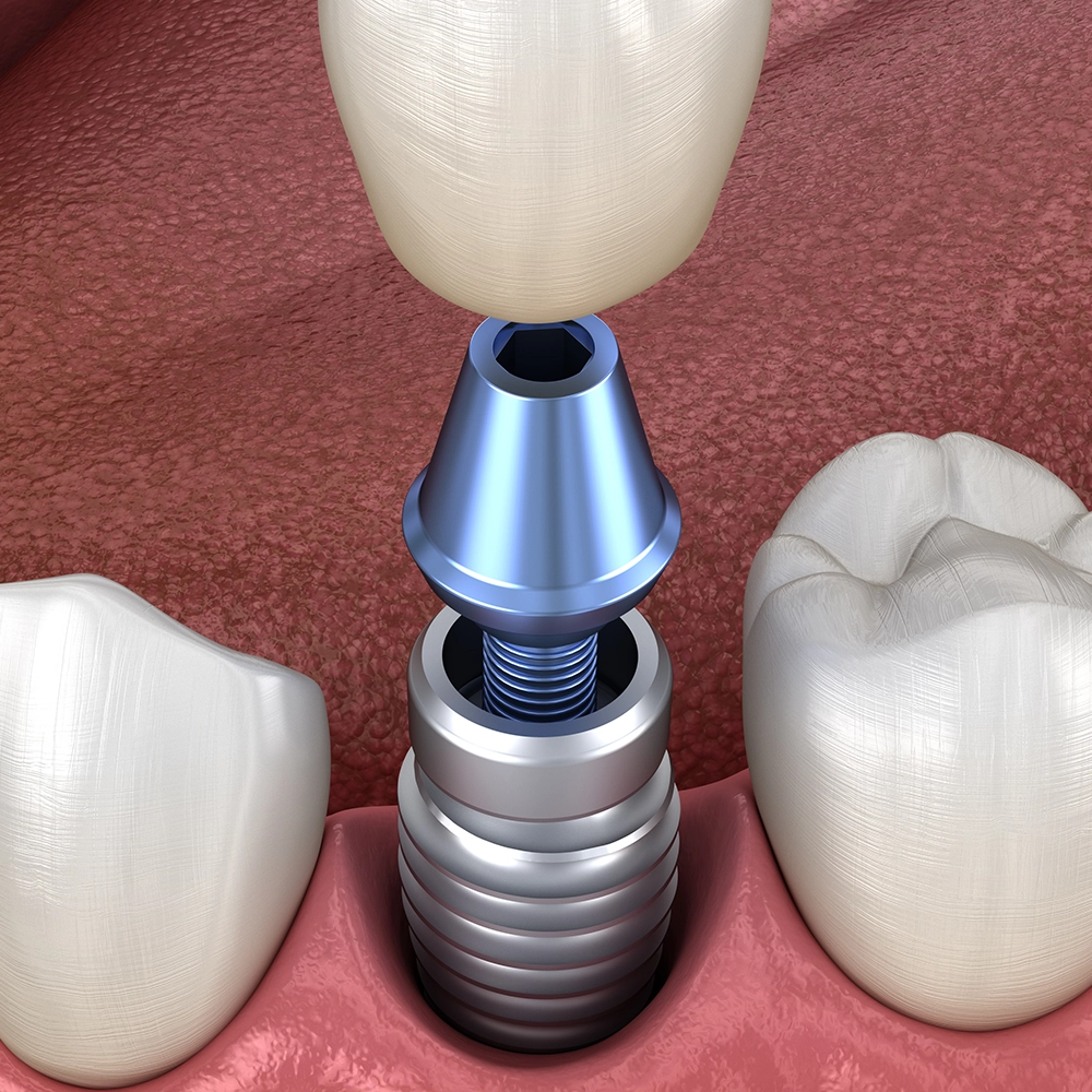 3D illustration of a dental implant crown being placed.