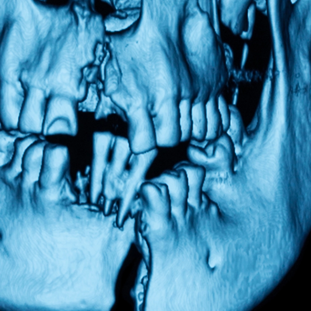 3D scan of a jaw showing trauma.