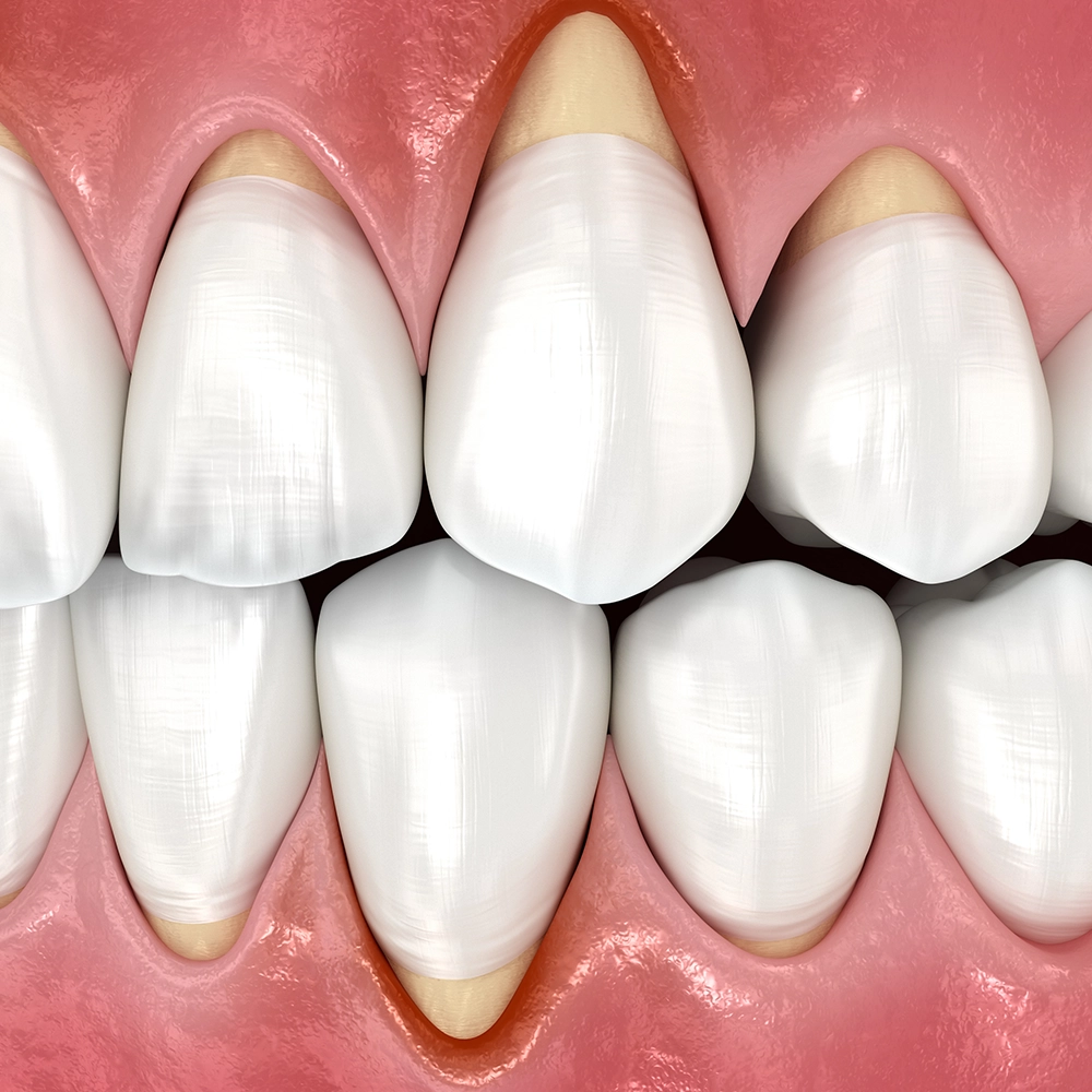3D render of teeth with receding gums.